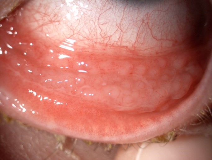 Conjunctivitis